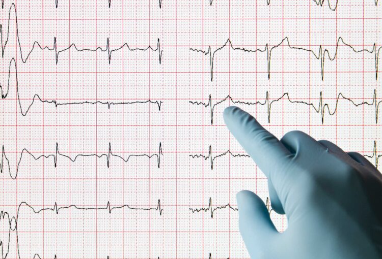 ECG