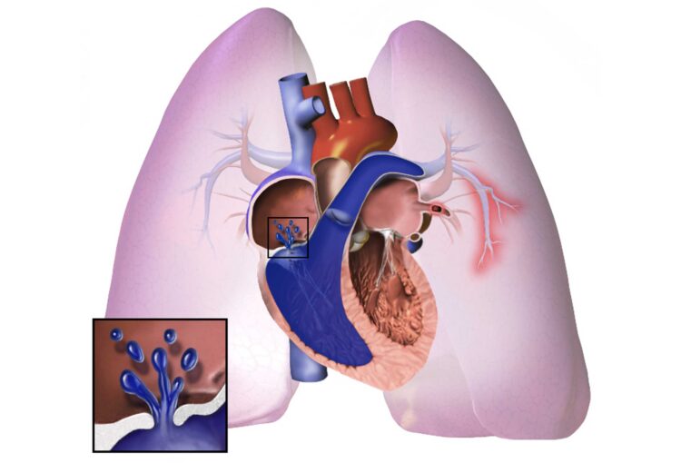 Plućna hipertenzija